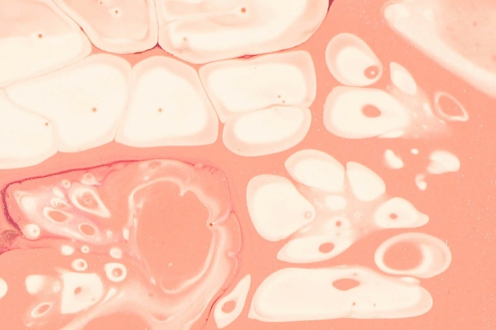 Radiesse focus Dr Alexis Granite