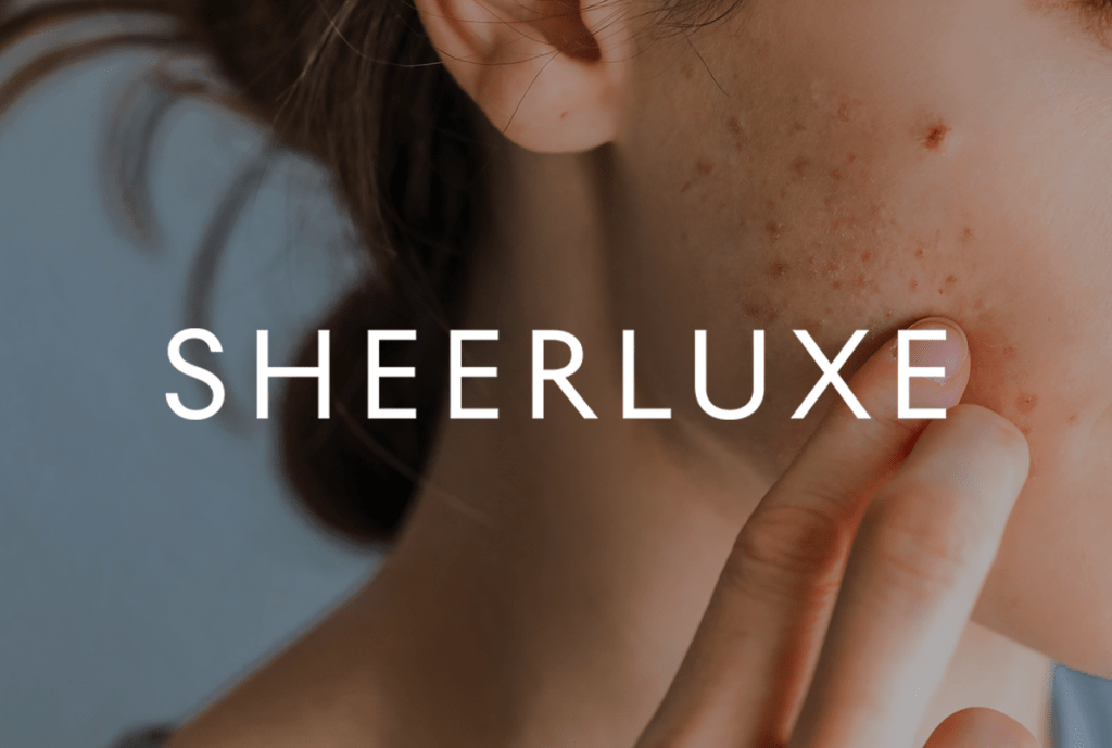 The SL Directory: Acne Experts